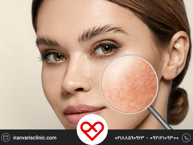 در مورد رگ‌های عنکبوتی صورت چه می‌دانید؟ | علت، درمان و پیشگیری