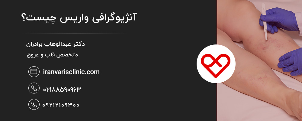 مزایای آنژیوگرافی واریس