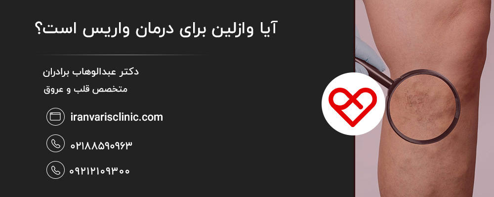 سایر توصیه ‌ها برای کاهش علائم واریس