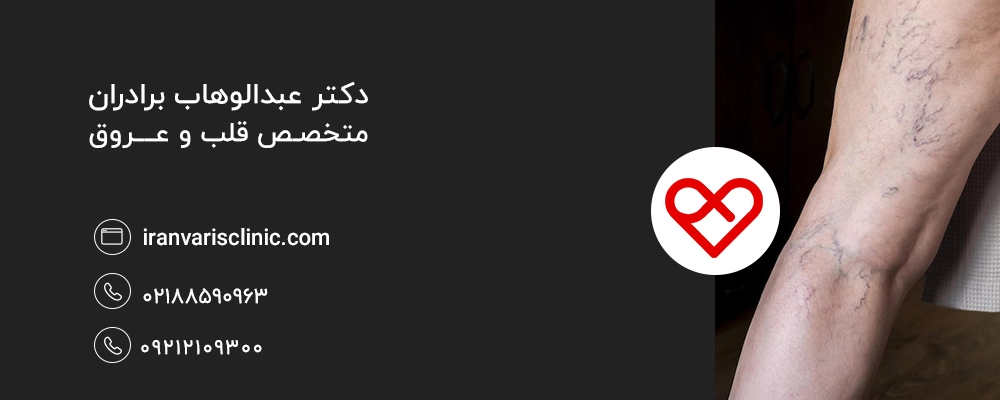درمان واریس ارثی