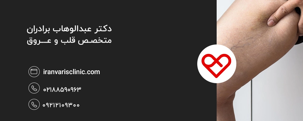 نقش ژنتیک در ایجاد واریس