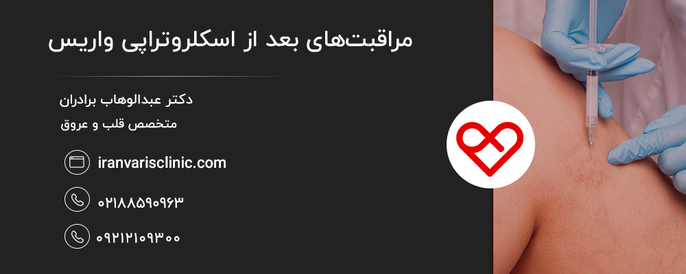 مراقبت‌های بعد از اسکلروتراپی واریس