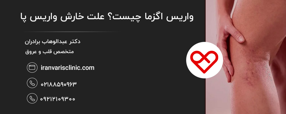 بررسی علل واریس اگزما