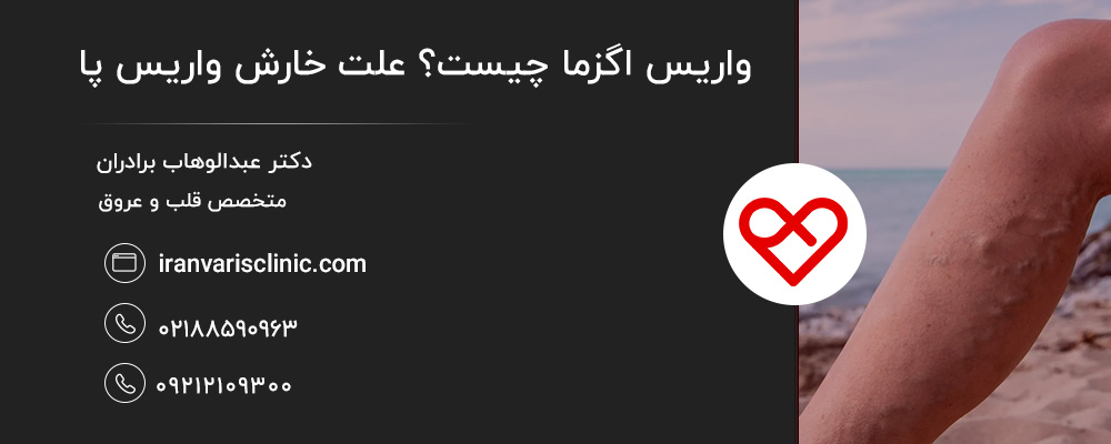 روش ‌های درمان و مراقبت از واریس اگزما