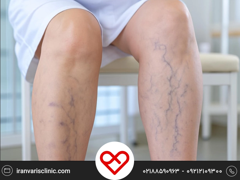 بررسی تاثیر اضافه ‌وزن و چاقی در تشدید واریس پا
