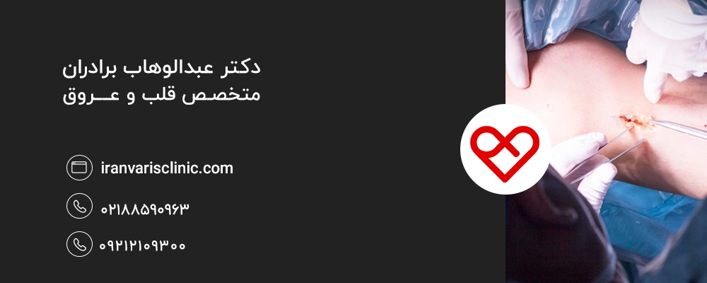 روش لیگاسیون واریس
