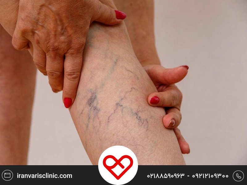 خطرات واریس در بیماران دیابتی