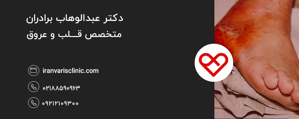  چرا واریس در بیماران دیابتی خطرناک‌تر است؟