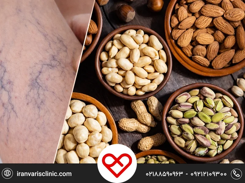 اهمیت تغذیه بعد از عمل واریس