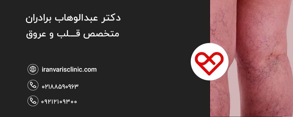  رگ عنکبوتی چیست و چه تفاوتی با واریس ریتیکولار دارد؟