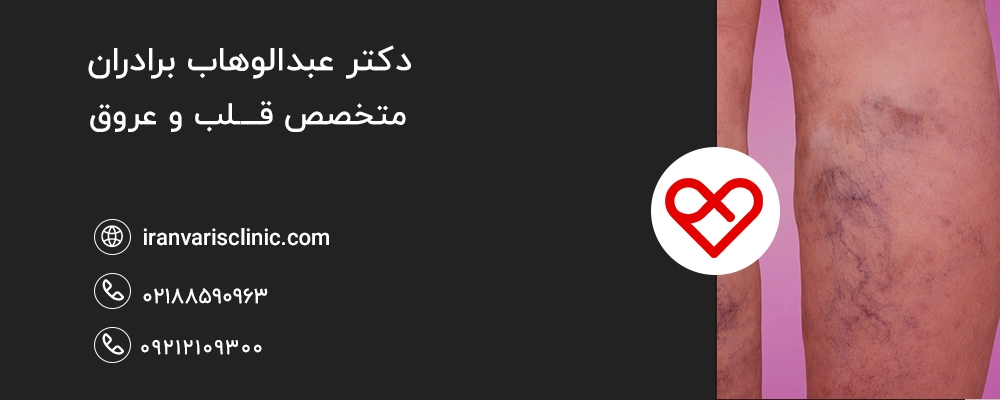  روش‌های درمان واریس ریتیکولار