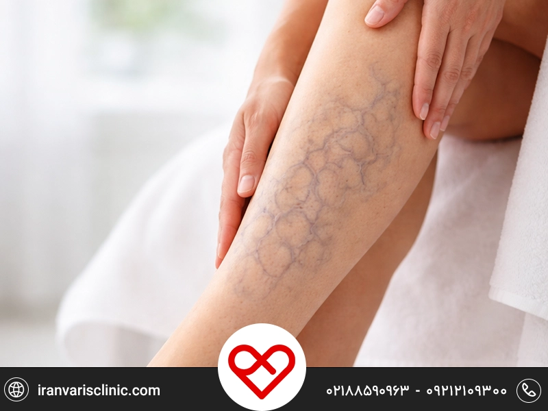 کمبود چه ویتامینی باعث واریس میشود؟