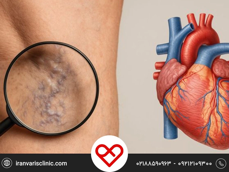 واریس و بیماری‌ قلبی چه ارتباطی با هم دارند؟