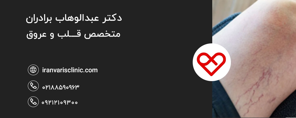  راهکارهای مقابله با تاثیر روانی واریس