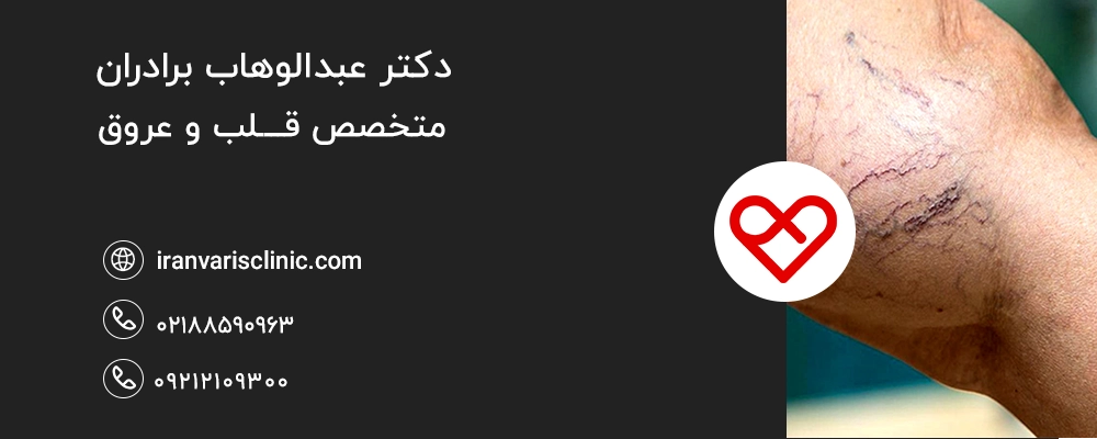 راه های پیشگیری و کنترل واریس در دوران یائسگی