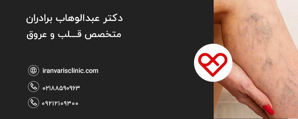 واریس چیست و چگونه ایجاد میشود؟