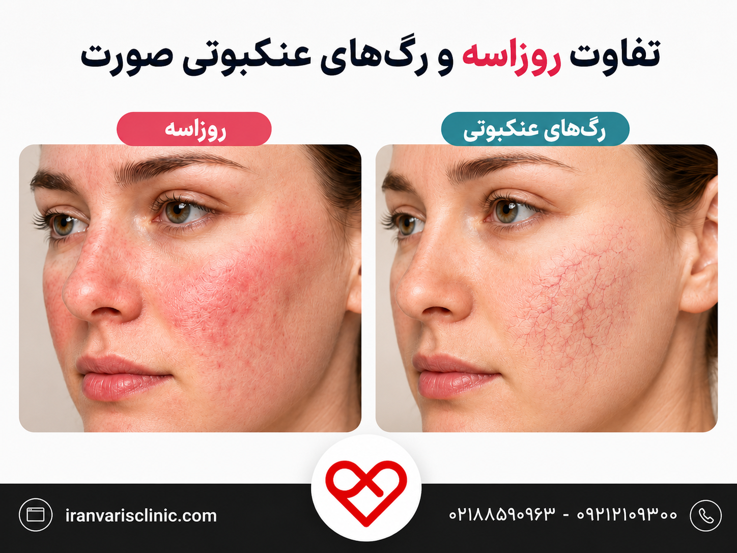 تفاوت روزاسه و رگ‌های عنکبوتی صورت چیست؟