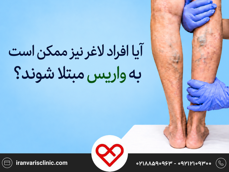آیا افراد لاغر هم به واریس مبتلا می‌شوند؟