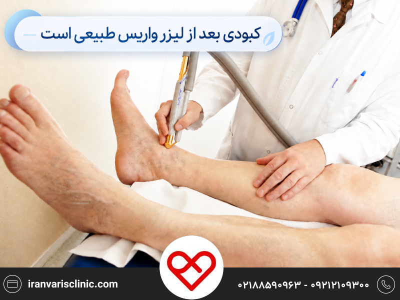 کبودی بعد از لیزر واریس طبیعی است