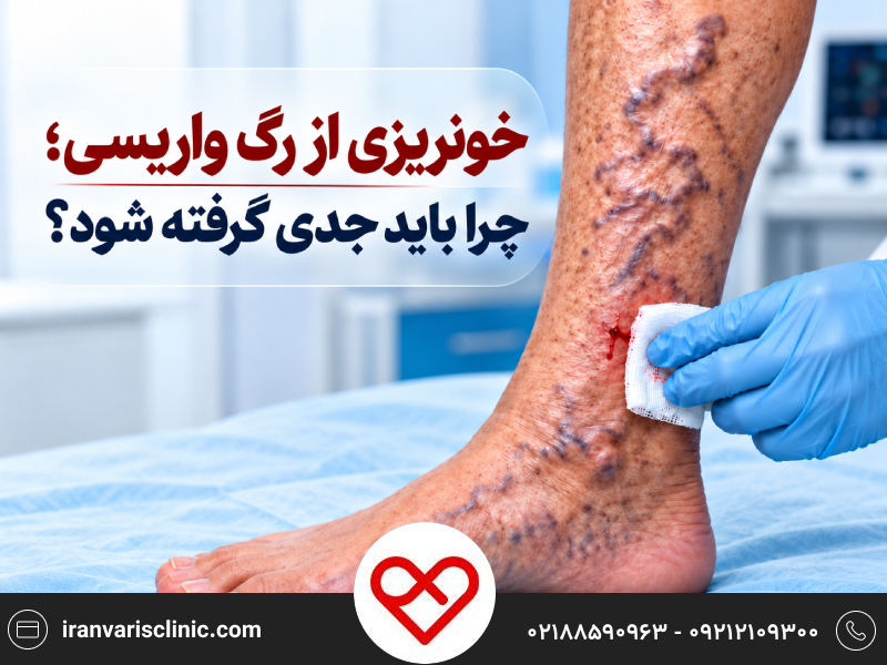 خونریزی از رگ واریسی؛ چرا باید جدی گرفته شود؟