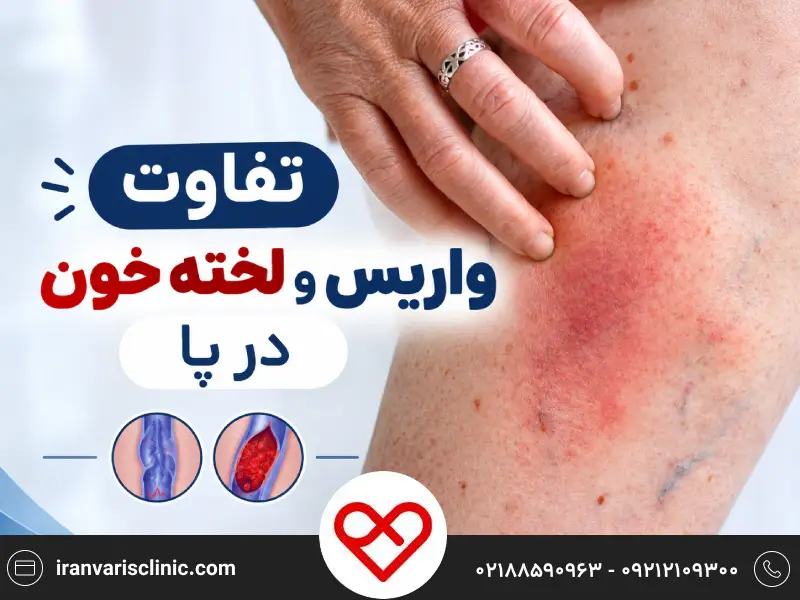 تفاوت واریس و لخته خون در پا